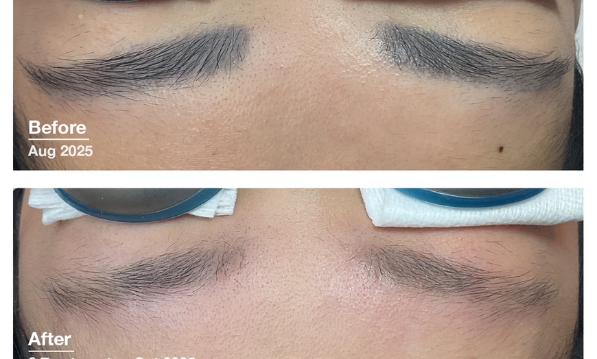 Image 6: Up to 30% Off on Tattoo Removal at Clarity Tattoo Removal