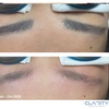 Image 6: Up to 30% Off on Tattoo Removal at Clarity Tattoo Removal