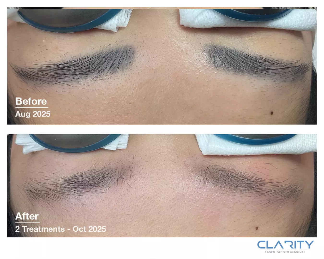 Up to 40% Off on Tattoo Removal at Clarity Tattoo Removal