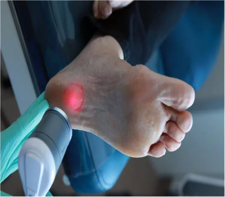Plantar Fasciitis treatment with One or Two Shockwave Therapy Session and Medical Foot Massage (Up to 75% Off) - Second Medium