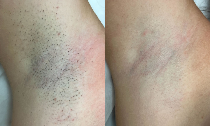Image 3: Up to 50% Off on Laser Hair Removal at Laser By Nicole Boca Raton