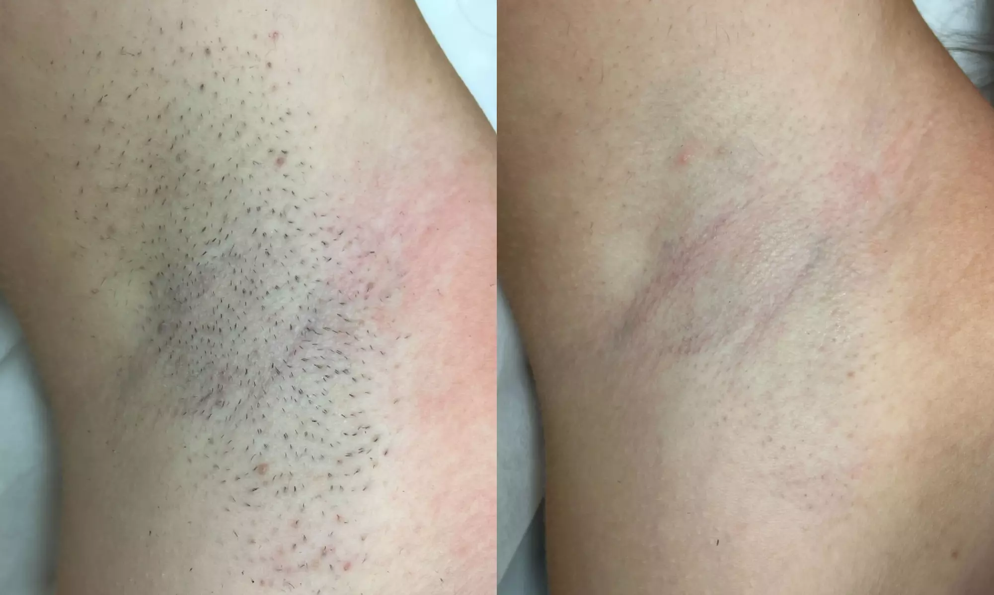 Up to 50% Off on Laser Hair Removal at Laser By Nicole Boca Raton