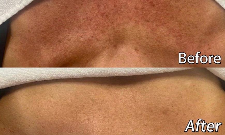 Image 3: 1 or 3 IPL Acne, Melasma, Brown Spots, or Rejuvenation Treatments
