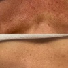 Image 3: 1 or 3 IPL Acne, Melasma, Brown Spots, or Rejuvenation Treatments
