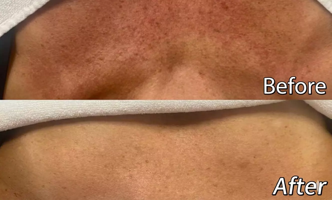 1 or 3 IPL Acne, Melasma, Brown Spots, or Rejuvenation Treatments