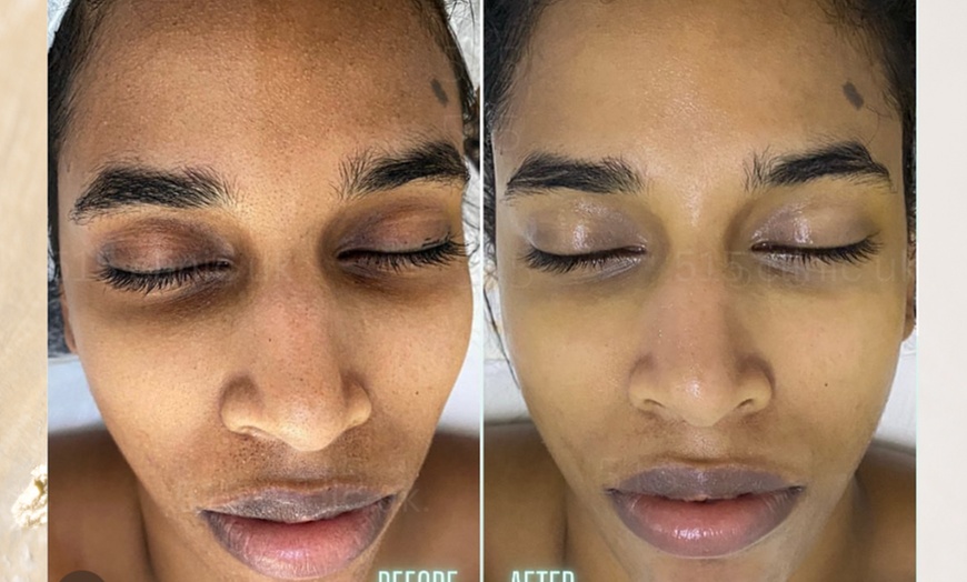 Image 6: Hydrate and Rejuvenate with Microneedling Treatments