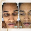 Image 6: Hydrate and Rejuvenate with Microneedling Treatments