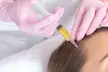 Transform with One PRP Therapy for Skin & Hair at UK Aesthetics Lounge (Up to 41% Off) - Second Medium