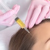 Image 2: Revitalize Your Look with One PRP Hair or Face Injectable  