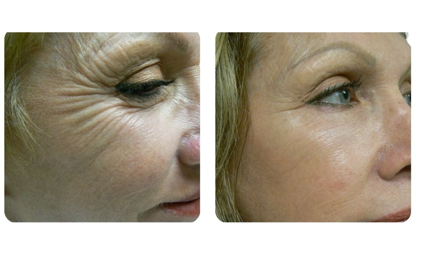 Image 2: Refresh Yourself with Xeomin Shots