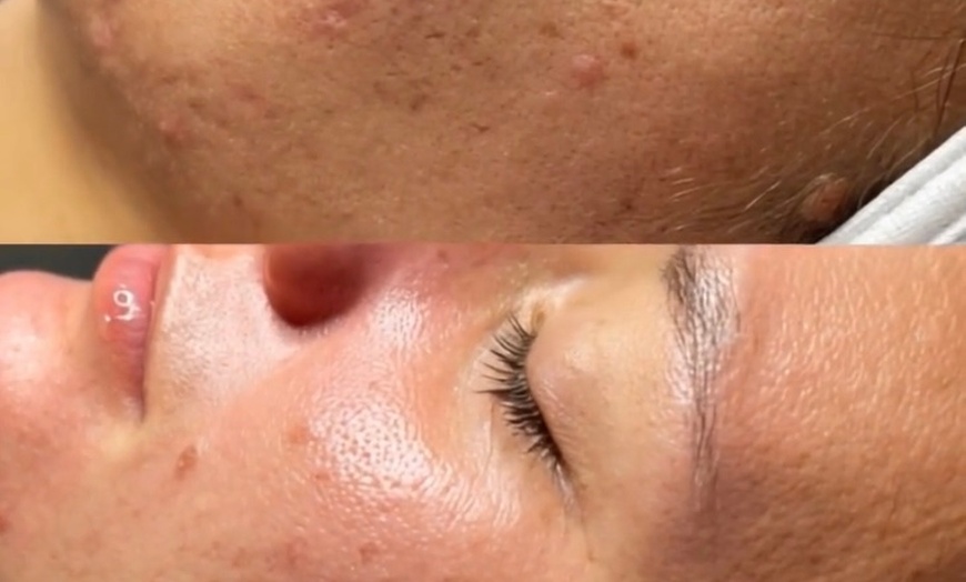 Image 1: Microneedling Glow Boost: Classic, Stem Cell & Vitamin C Options