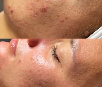 One Session of Classic Microneedling with Hyaluronic Acid - Kolcheva Skin and Laser clinic
