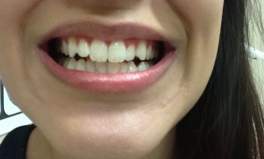 Image 1: In-Chair LED Teeth Whitening