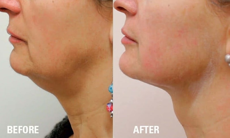 Image 3: Explore HIFU Treatments for Face, Neck, and Body