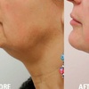 Image 3: Explore HIFU Treatments for Face, Neck, and Body