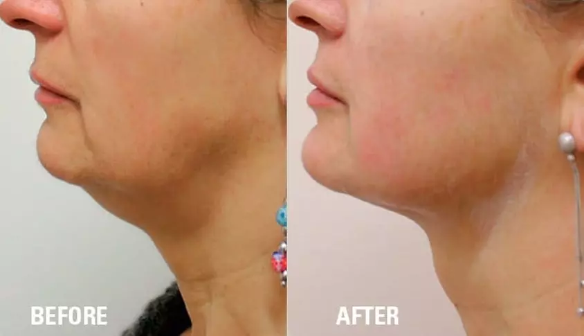 Explore HIFU Treatments for Face, Neck, and Body
