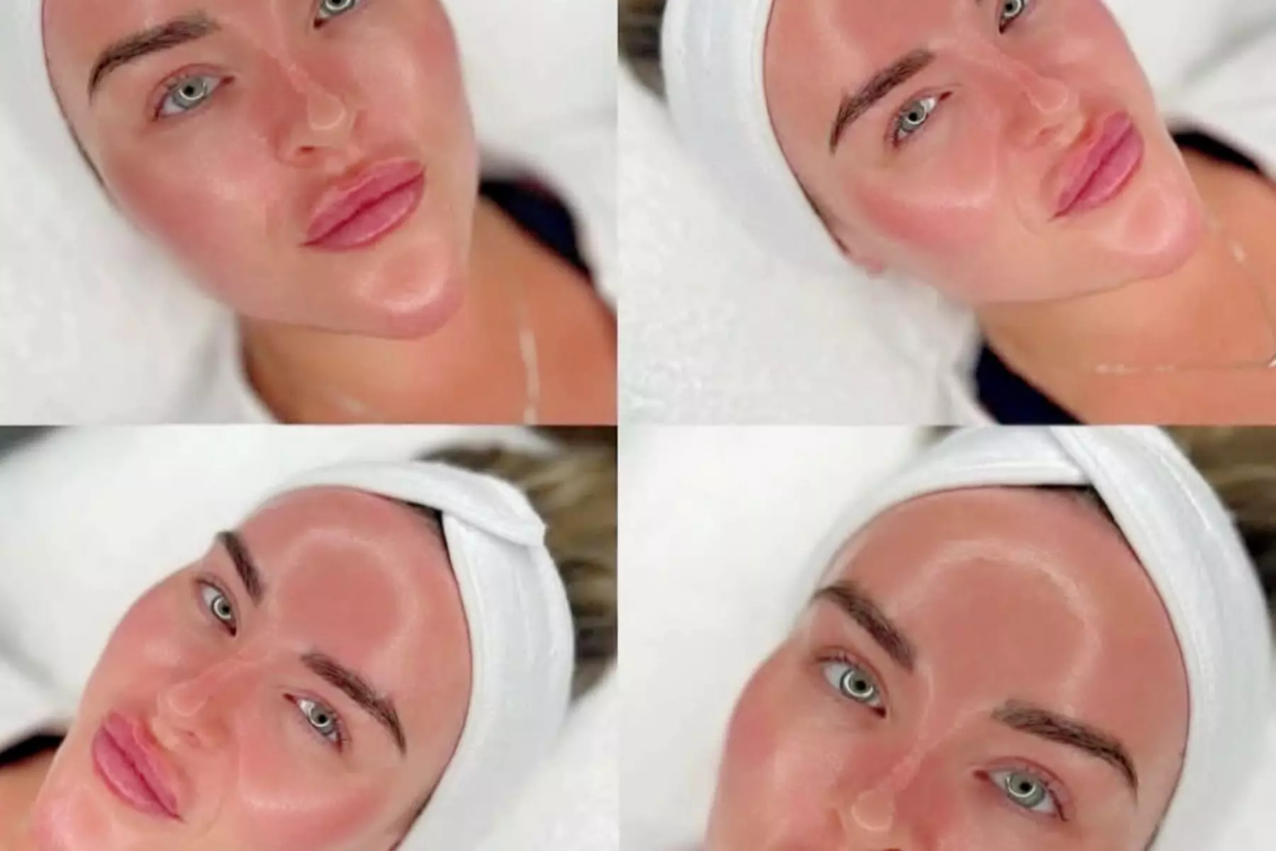 Microdermabrasion and Brightening Medical-Grade Facials