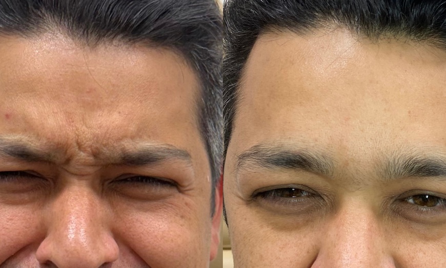 Image 3: Smooth Away Wrinkles with 20, 40 or 60 Units of Xeomin