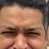 Image 3: Smooth Away Wrinkles with 20, 40 or 60 Units of Xeomin