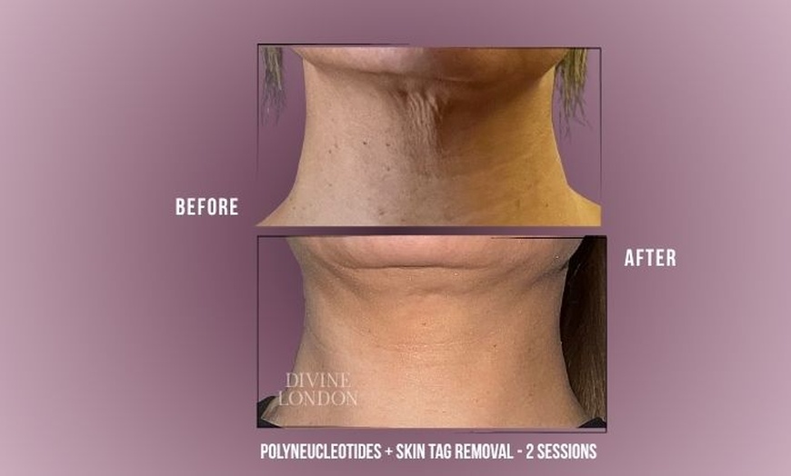 Image 3: Polynucleotides Regenerative Treatment at Divine Aesthetics in London