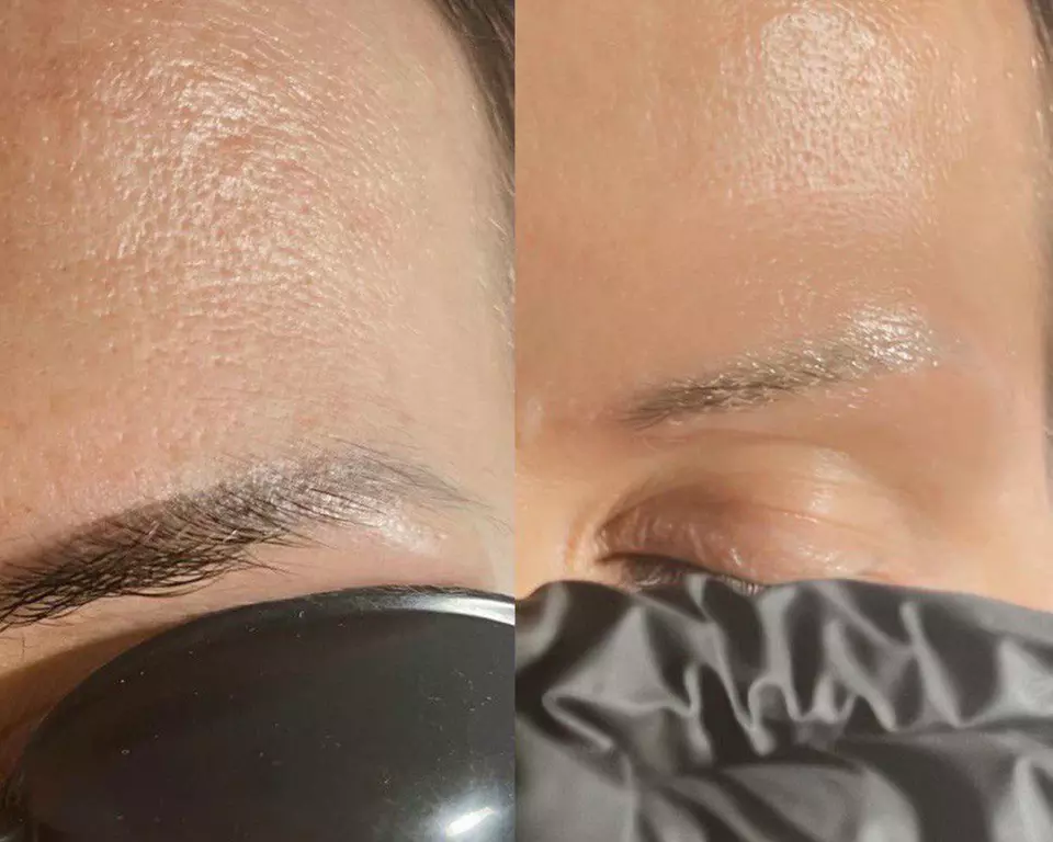 Laserowe usuwanie tatuażu lub makijażu permanentnego brwi