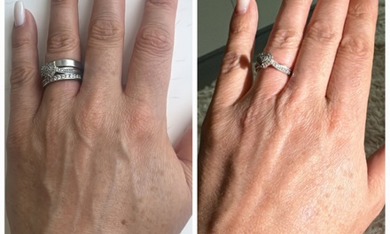 One Laser Skin Hand Rejuvenation Treatment - Med Therapy and Spa