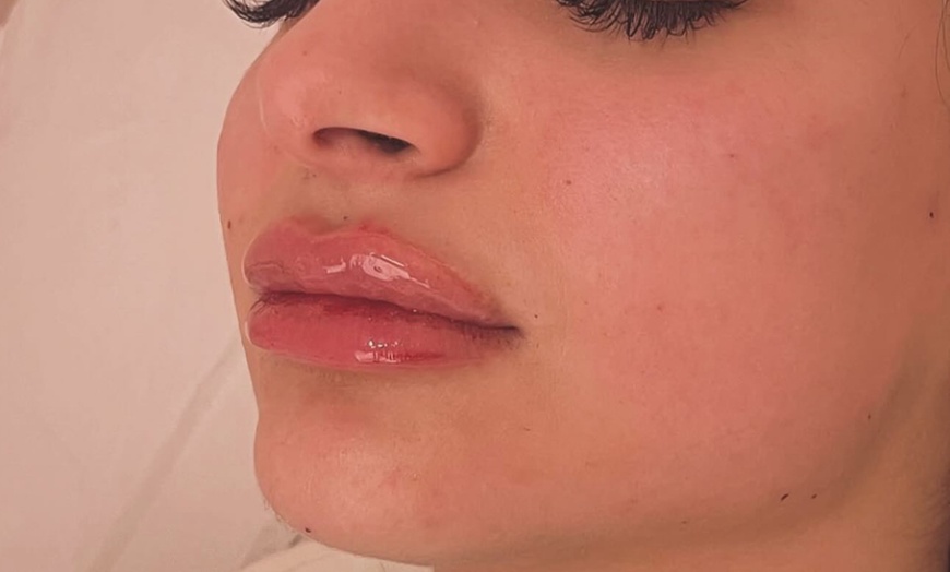 Image 4: Enhance Your Lips with 0.5ml or 1ml Lip Filler with Consultation