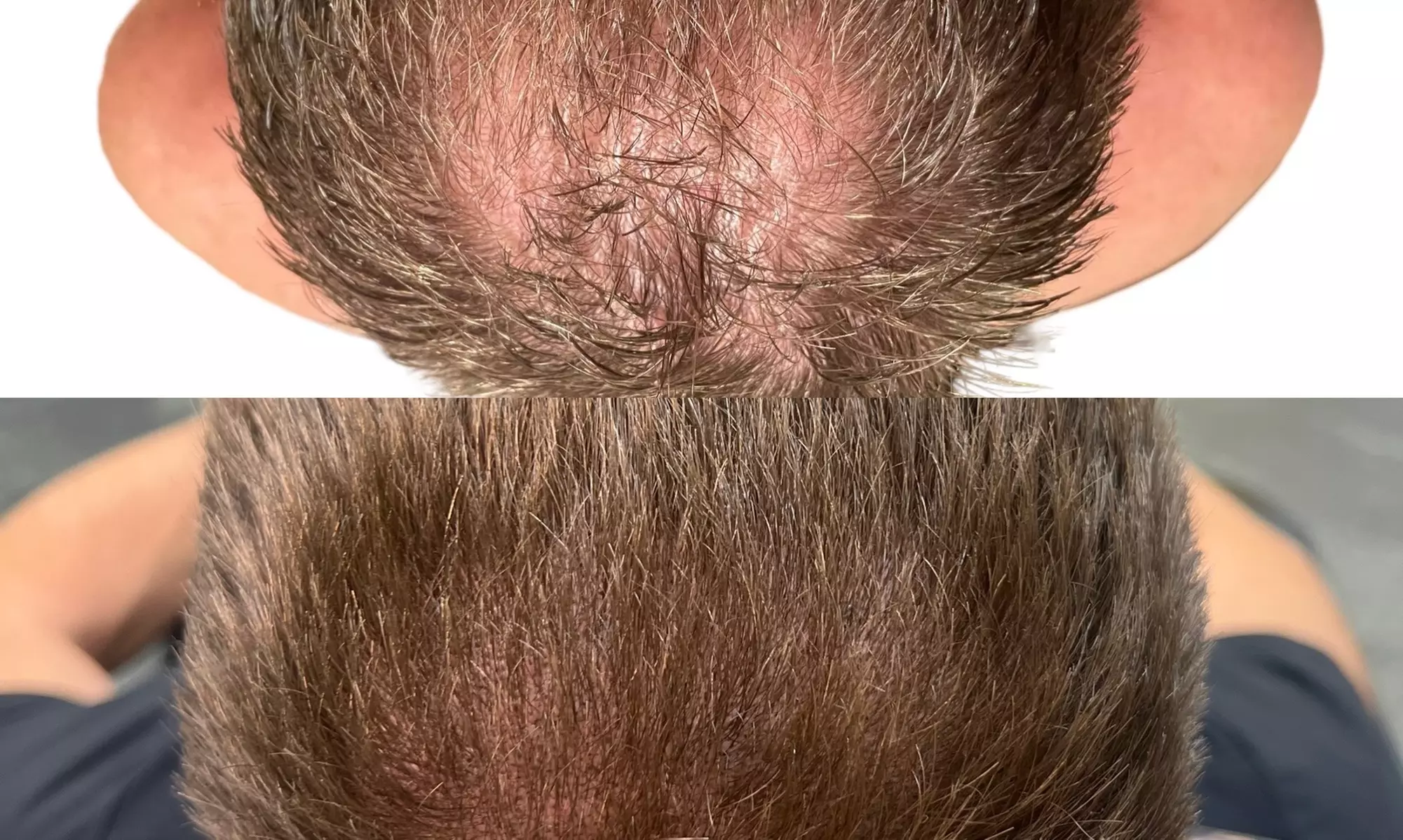 Transform Your Look with Hair Restoration Magic! Micropigmentation