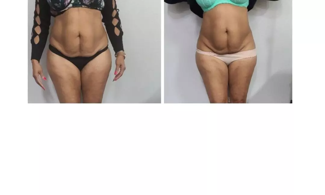Up to 75% Off on Ultrasonic Fat Reduction at Bodied By Ray - Primary Image