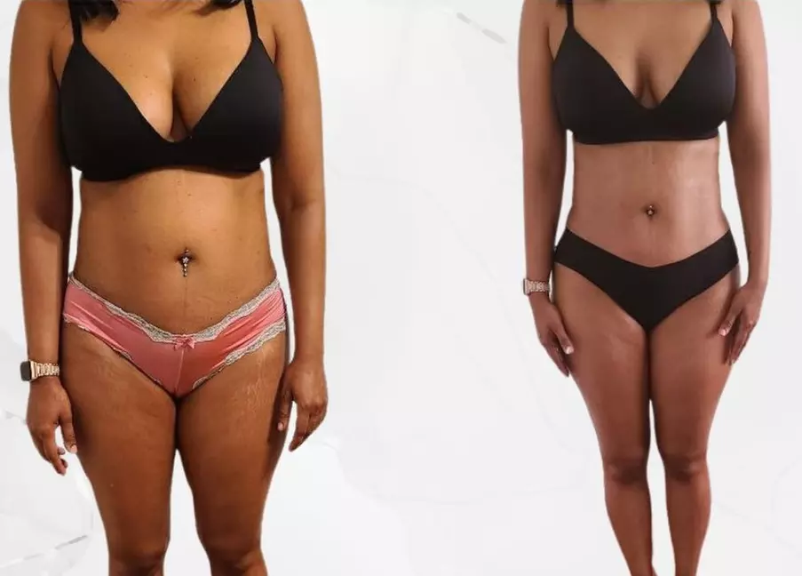Up to 75% Off on Ultrasonic Fat Reduction at Bodied By Ray - Second Medium