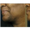 Image 1: Up to 40% Off on Laser Hair Removal at Bella Medical Aesthetics