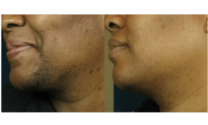 Up to 58% Off on Laser Hair Removal at Bella Medical Aesthetics