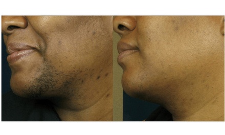 3 Total Body Laser Hair Removal Sessions  with Cool Air Therapy - Bella Medical Aesthetics