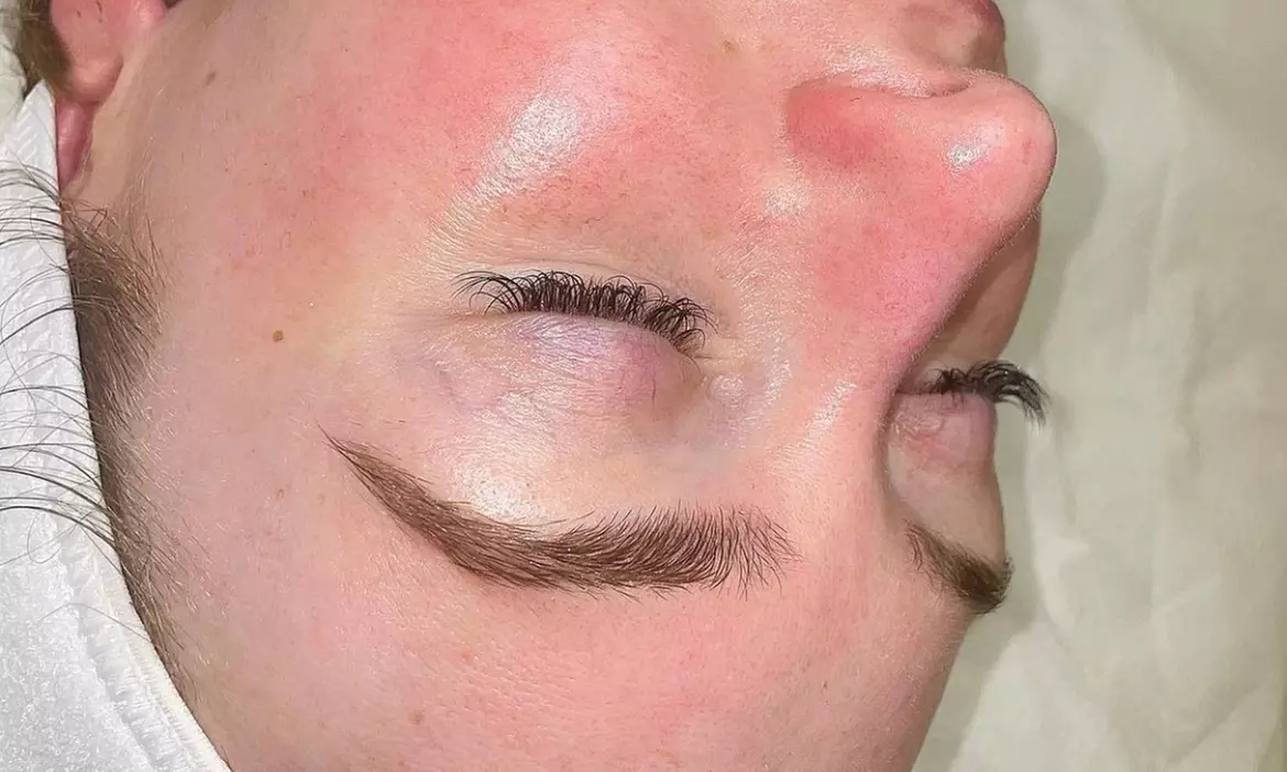 Up to 32% Off on Microdermabrasion at Skin Haven