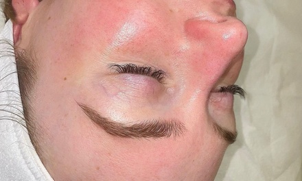 Microdermabrasion treatment - Skin Haven