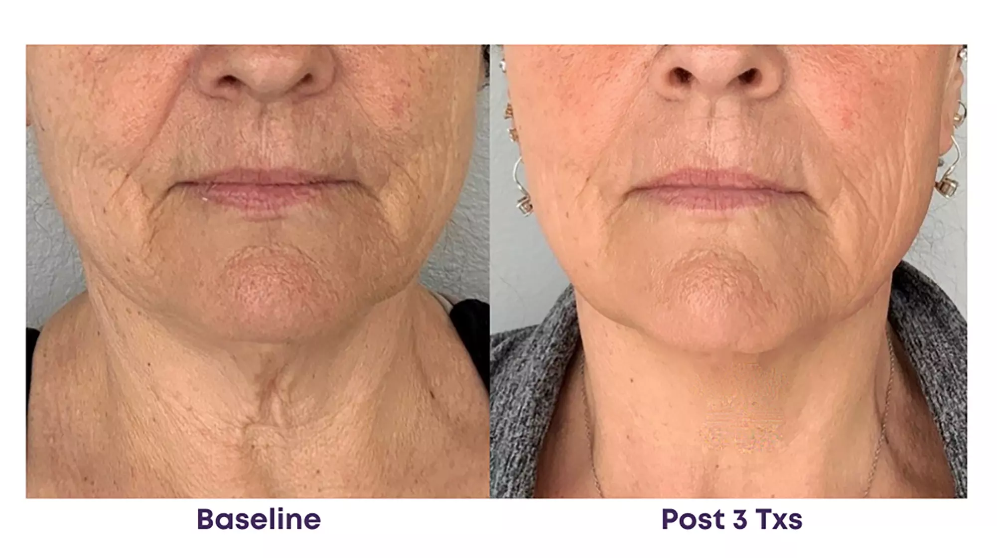 Experience Rewind Advanced Aesthetics'  Skin Tightening for Stomach, Eyes, Neck, or Knees (Up to 40% Off)