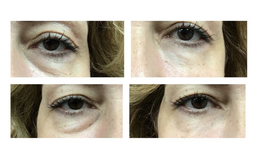 Image 3: One Belotero syringe for undereyes