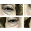 Image 3: One Belotero syringe for undereyes