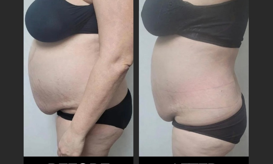 Image 2: One 30-Min EMS Body Contouring session on the Abdomen or on the Glute