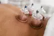 Revitalize with 1 or 3 Acuwave Detox Cupping Sessions for 30 Mins at AcuWave Clinic (Up to 60%Off) - Second Medium