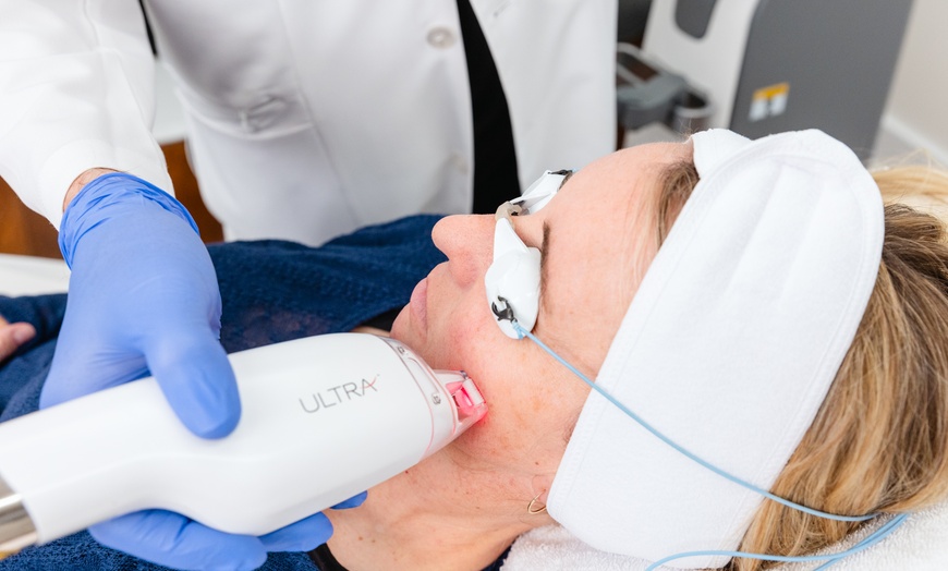 Image 2: Non-Ablative Fractional Laser - LaseMD Ultra for Stretch Marks, Face, Neck, or Hands at Loma Laser (Up to  45% Off)