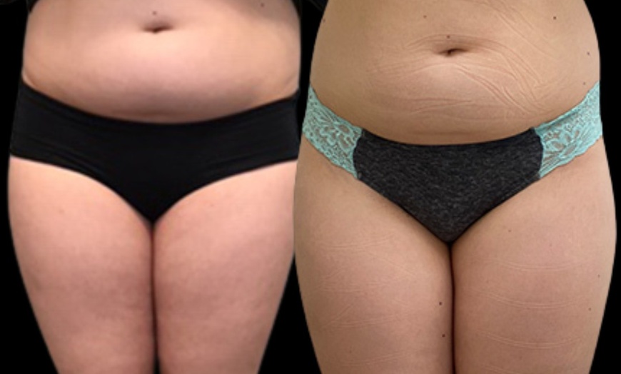 Image 2: Up to 67% Off on Cavitation at Atlanta Body Sculpt