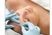 Up to 53% Off on Micro-Needling at Refined Radiance Aesthetics, Westlake Village - Second Medium