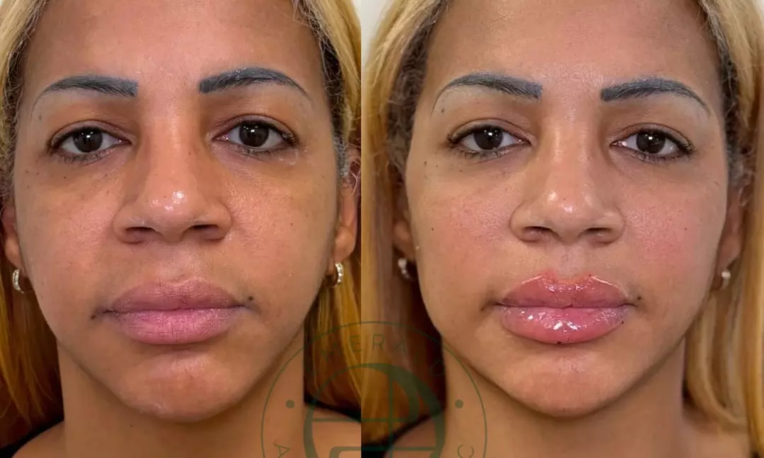 Luxe filler- of botoxbehandeling bij Emerald Aesthetic Clinic