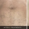 Image 3: Up to 50% Off on Laser Hair Removal at The Glam House Clinic