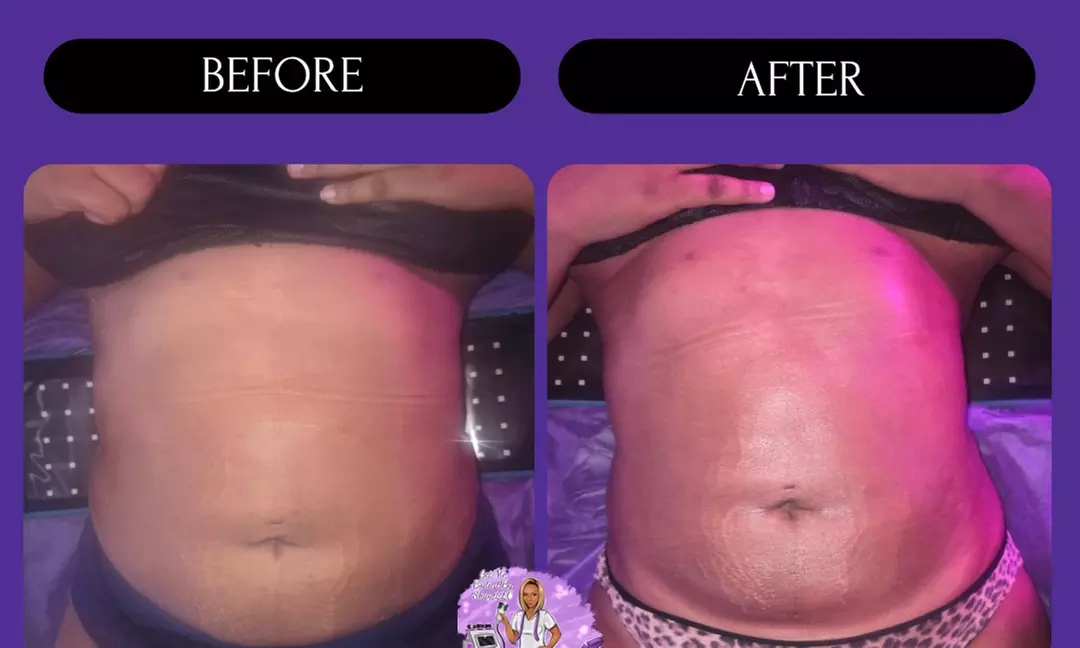 Post-Op Lymphatic Drainage Massages with Optional Wood Therapy