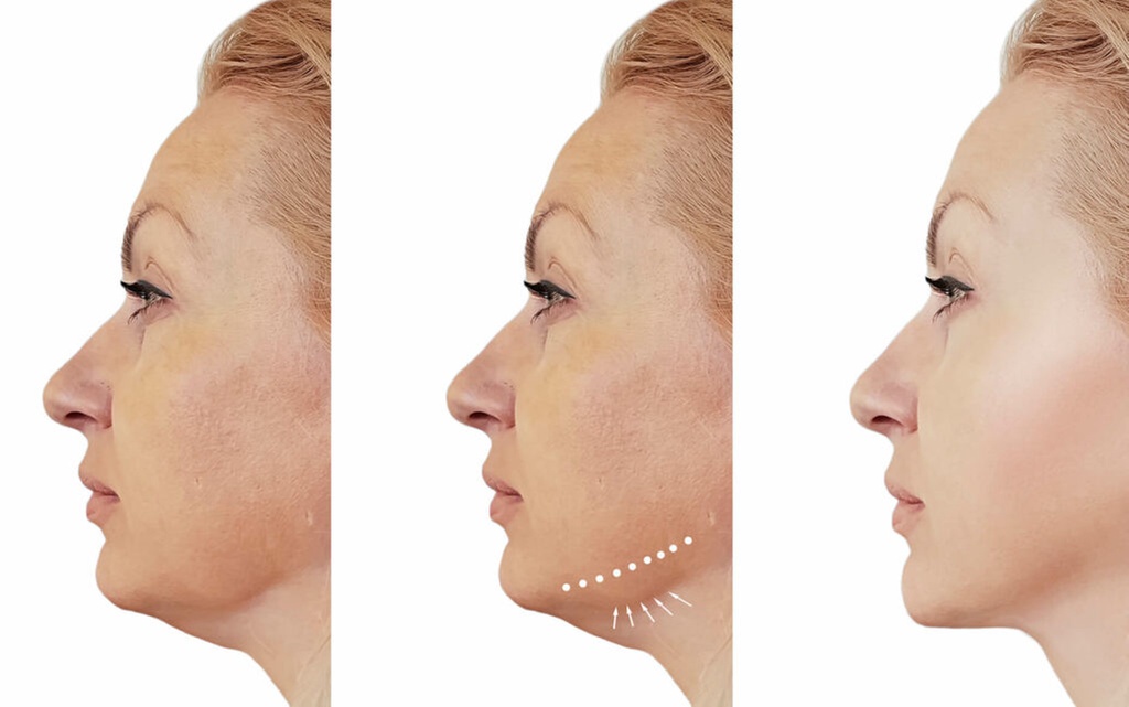 Transform w/ One or Two-Vial Fat Dissolving Injections on Double-Chin LemonBottle (Up to 60%Off)