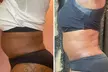 Up to 50% Off on Lipo - Non-Invasive Laser-iLipo at Extreme body sculpting - Second Medium