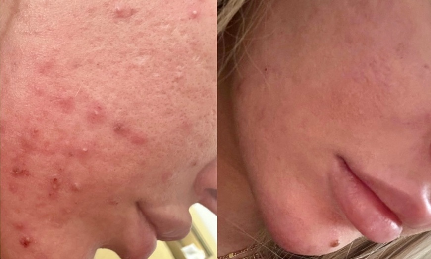 Image 2: Experience a Revitalizing VI Peel or Diamond Glow Facial at Enigma Medi Spa & Laser Center (Up to 44% Off)