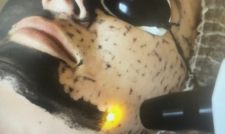 1x 60 Min. Carbon-Laser-Peeling mit Hyaluron- & Intensivpflege-Ampulle für 1 Person - Claude Cosmetics